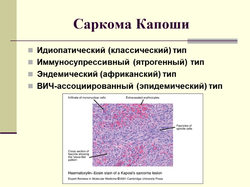 Саркома Капоши  Идиопатический (классический) тип Иммуносупрессивный (ятрогенный) тип  Эндемический (африканский) тип 